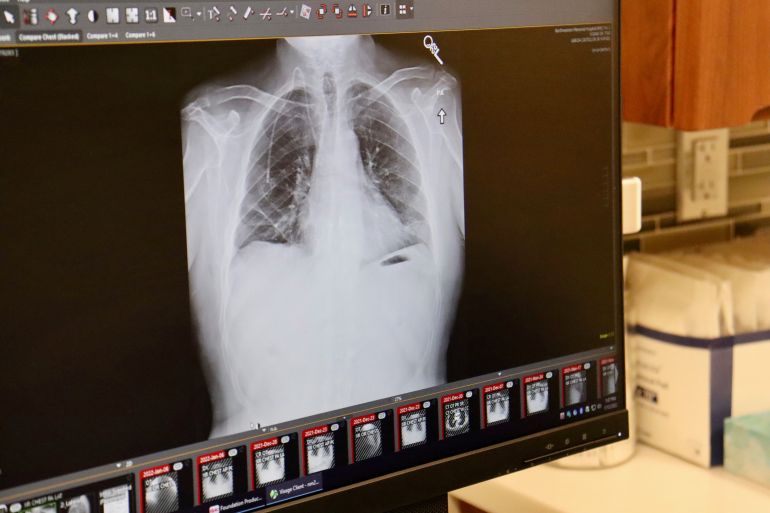 Un tratament pentru cancer pulmonar are rezultate impresionante și reduce la jumătate riscul de deces