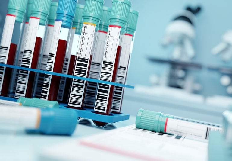 Un test de sânge ar putea identifica urmele de cancer în organism. Cât valorează dispozitivul