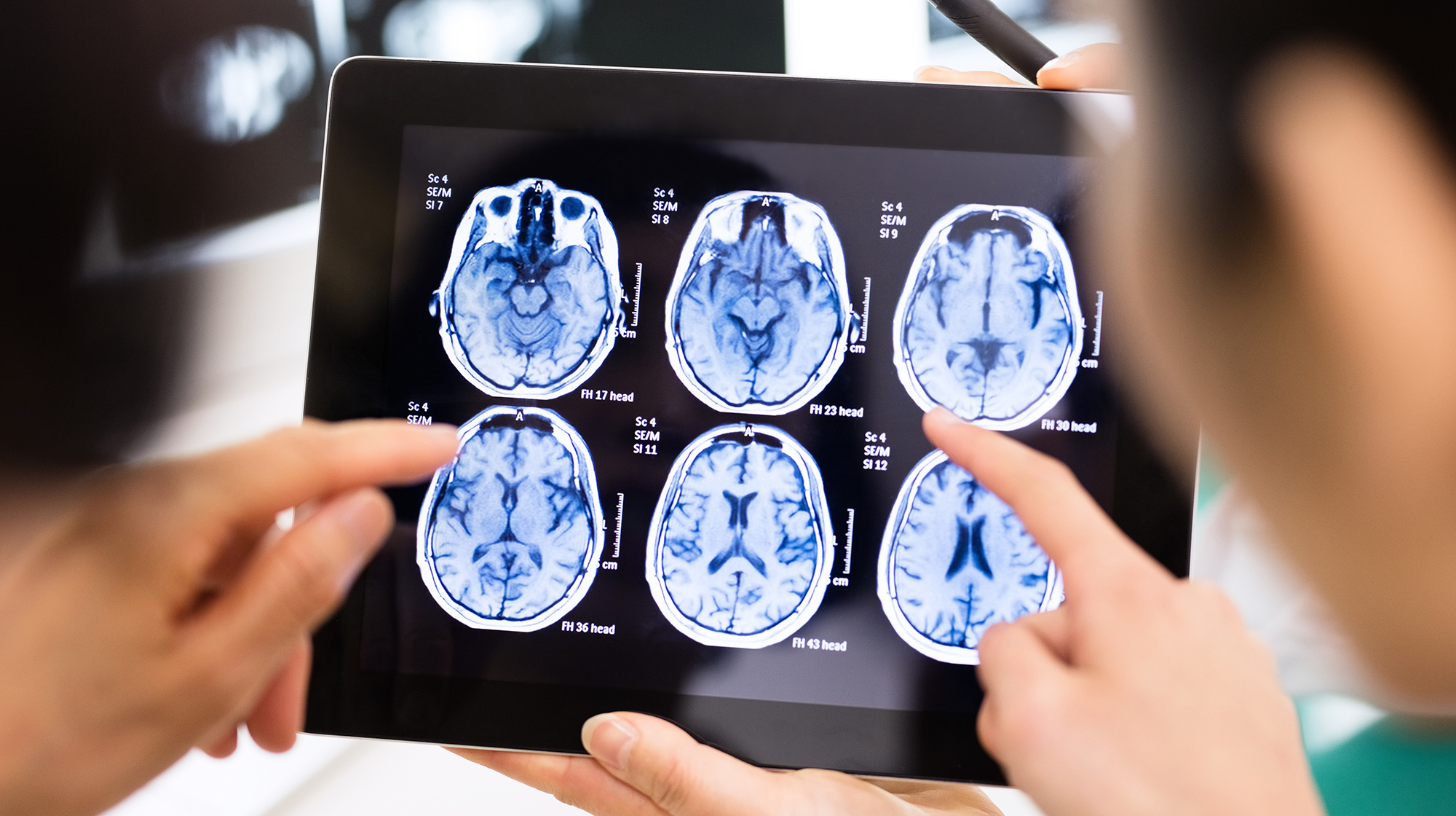 Implanturile cerebrale au reușit să trateze leziuni traumatice
