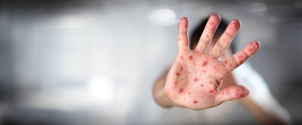 445 de cazuri noi de rujeolă au fost confirmate în ultima săptămână în România