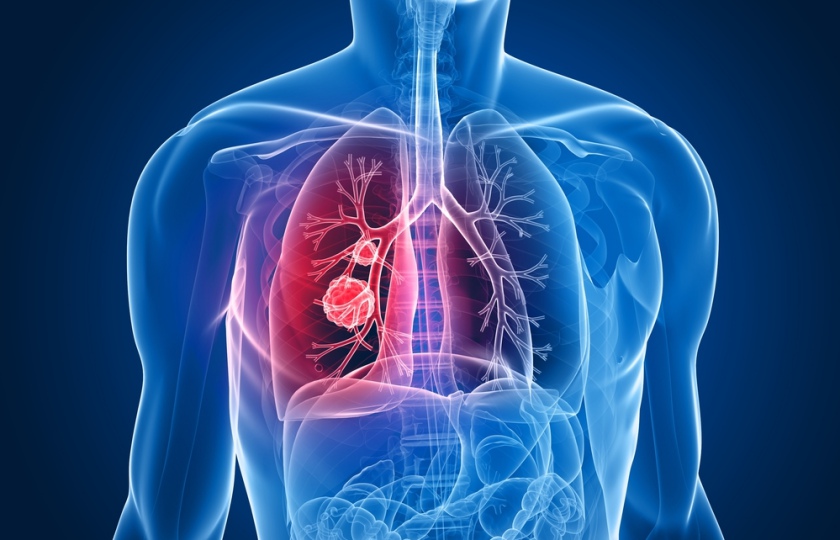 STUDIU. Care ar putea fi cauza cancerului pulmonar?