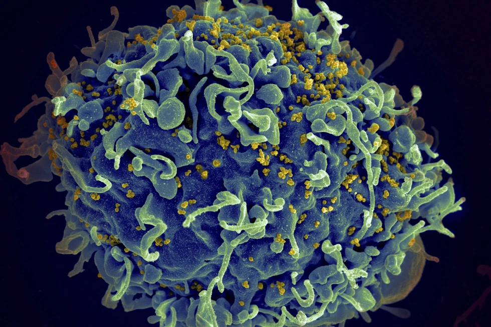CDC a identificat primul caz de HIV prin proceduri cosmetice
