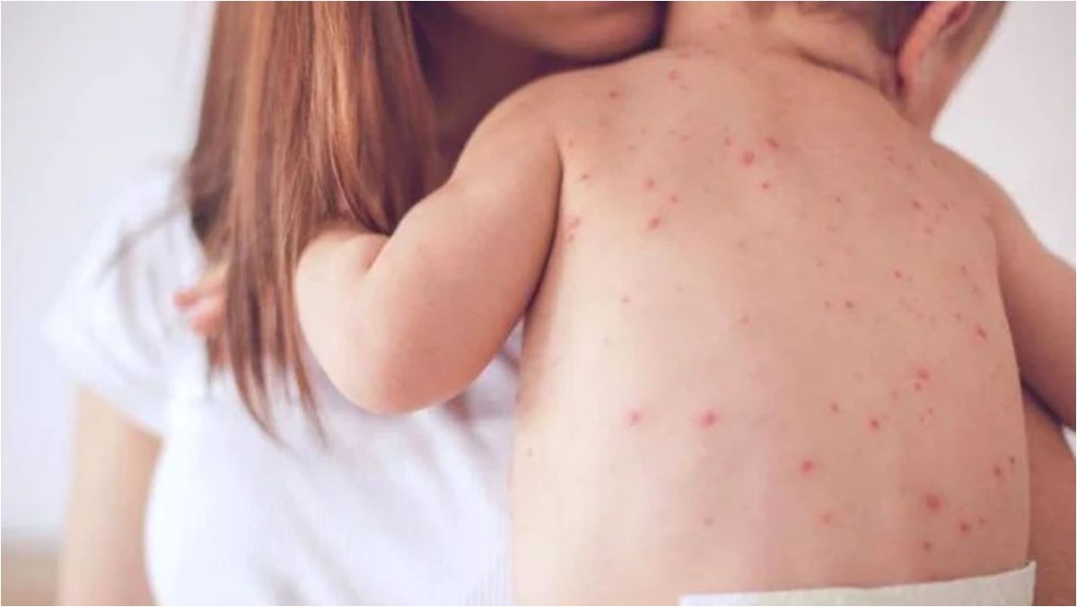Rujeola rămâne o problemă de sănătate în România