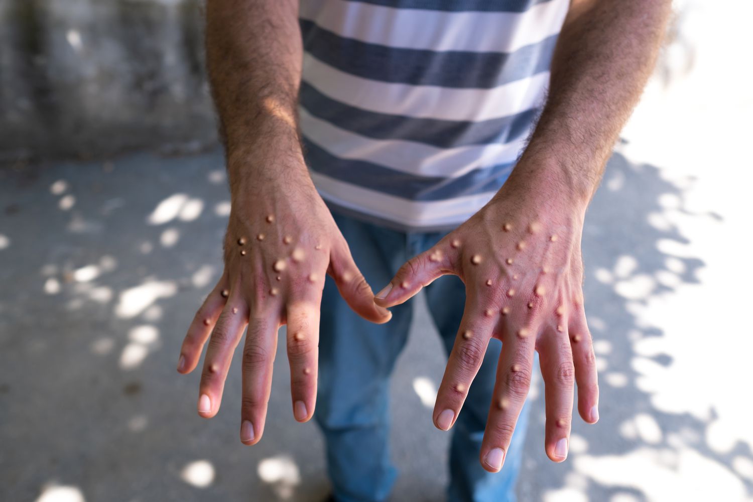Un prim caz de infectare cu mpox a fost confirmat în Germania 