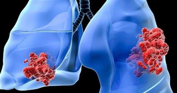 Peste o mie de englezi dezvoltă cancer pulmonar anual