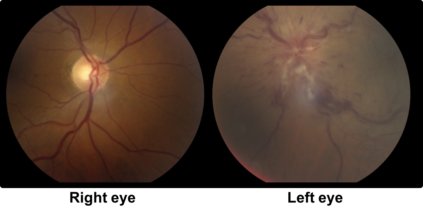 Pacienții cu NAION ar putea beneficia de un tratament revoluționar