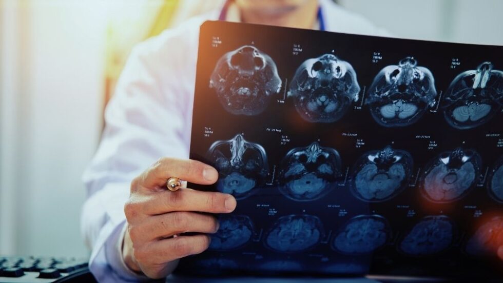 România are cea mai mare rată de mortalitate prin AVC din Europa